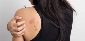 Can Taking Collagen Cause Skin Rash? — Christine Dionese